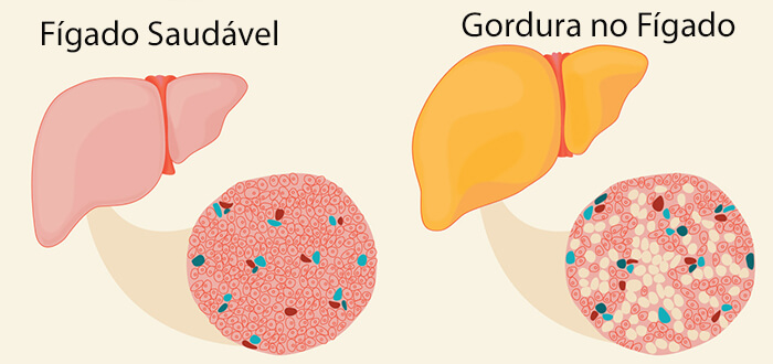 Gordura no fígado - fígado bom X gordura no fígado