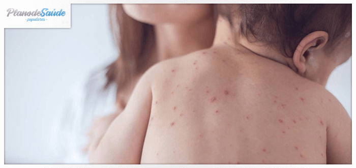 sintomas de sarampo-capa