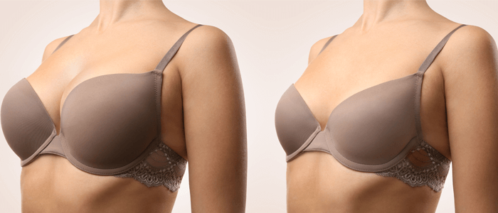 redução de mama - texto