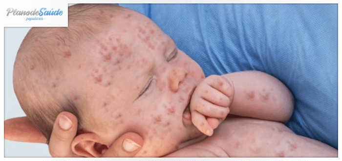 vacina contra o sarampo - capa