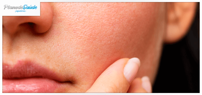 Mulher passando os dedos na pele do rosto - micose de pele