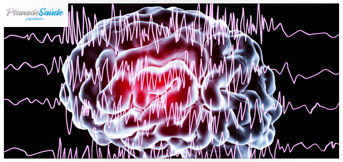 Representação 3D de ondas cerebrais alteradas - crise epiléptica